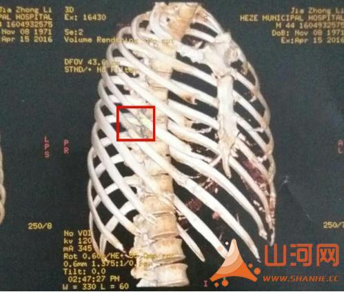伤者伤后2016-3-24,2016-3-26ct(首次曹县县医院)片示右侧第六肋骨