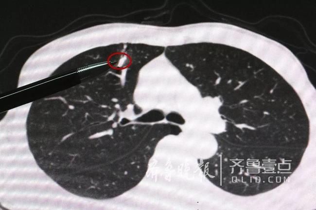 打工男子胸部意外"中弹"危及生命