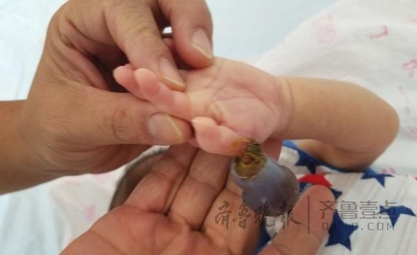 女婴出生手指携带葡萄状肉瘤