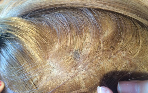 临沂女孩染发后头皮流脓 理发店称这是正常现象