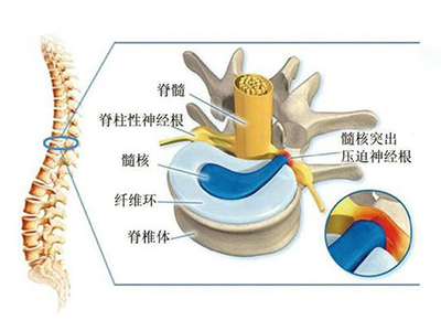 椎间盘突出症真有那么可怕吗